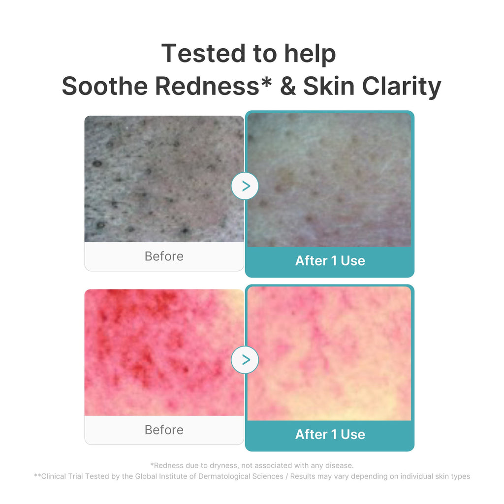 Azelaic Acid Capsule Foam Cleanser - Smooth Medicube Style